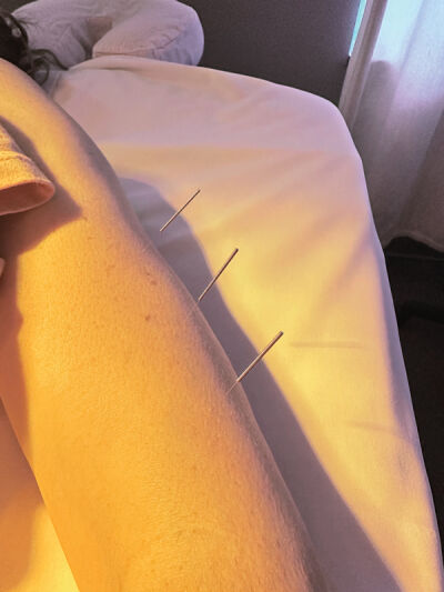  Acupuncture is a technique that utilizes flexible needles to address  issues within the body by targeting  specific points in the fascia layer. 